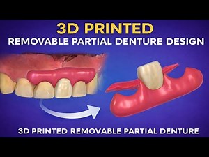 3D Printed Removable Partial Denture Design | Exocad Digital Workflow