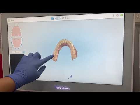 Itero for invisalign scanning