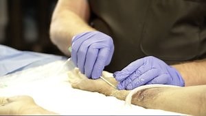 Practical Approach to Radial Artery Access