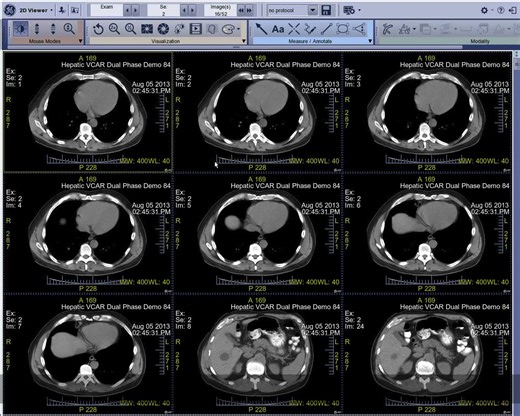 GE AW4.7工作站图像后处理教程