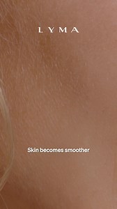 This is how the LYMA Laser works inside the skin, powerful cutting-edge science that delivers revolutionary results: skin density increases, skin becomes smoother and wrinkles decrease. | LYMA