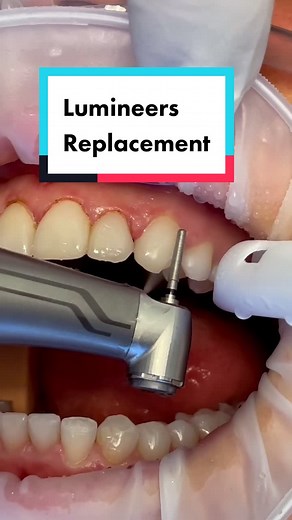 Revolutionizing Dental Work: Step One of the Lumineers Replacement Process