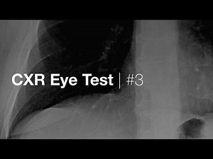CXR Eye Test #3