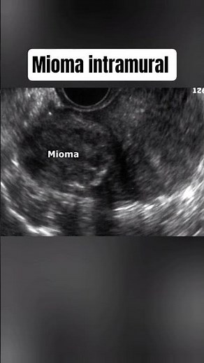 Mioma intramural #miomatosis #mioma #miomaintramural