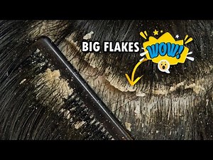 Scratching Psoriasis Scalp Big Flakes!!! Dandruff Scratching Satisfying #313