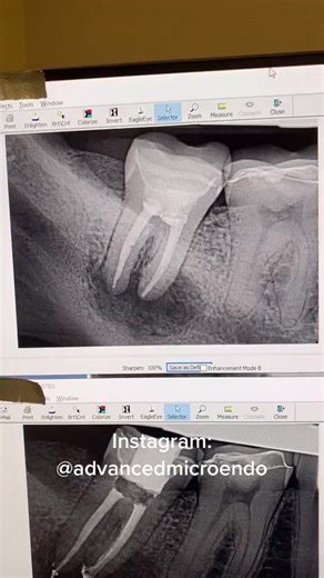19K views · 161 reactions | #dentistry | Advanced Micro-Endodontics | Facebook