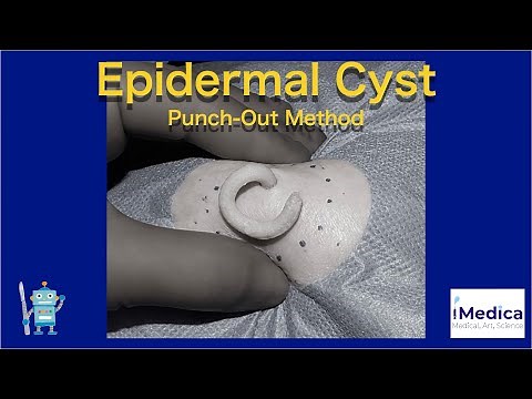 Punch-Out Method for Epidermal Cyst | Small Cut, Big Results