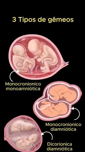 JUJUBA KIDS on Instagram: "1. Gêmeos Monozigóticos (idênticos) Formação: Ocorrem quando um único óvulo é fecundado por um único espermatozoide, formando um zigoto que se divide em dois embriões. Características: Os gêmeos são geneticamente iguais, resultando em aparências muito semelhantes e sendo sempre do mesmo sexo. 2. Gêmeos Dizigóticos (fraternos) Formação: Desenvolvem-se a partir de dois óvulos diferentes que são fecundados por dois espermatozoides distintos, criando dois zigotos separados