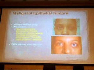 lacrimal gland tumers Ehab Saad