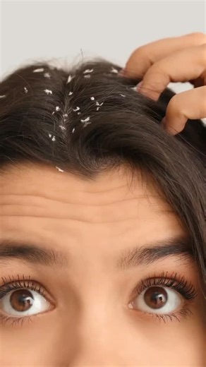 VED HERBS | HERBAL SKIN AND HAIR CARE on Instagram: "Dandruff, itchy scalp, hair fall? 🌿 Heal your scalp first with Ved Herbs Hair Growth Hair Pack for naturally healthy, strong hair. 🌿 Key Benefits ✔ Clears dandruff & scalp buildup naturally ✔ Soothes itchy, irritated scalp ✔ Controls excess oil & scalp infections ✔ Strengthens roots and reduces hair fall ✔ Boosts healthy hair growth from the scalp ✔ Improves hair texture, shine & thickness 🌱 Ingredient Power 🌿 Poduthalai & Neem – dandruff 