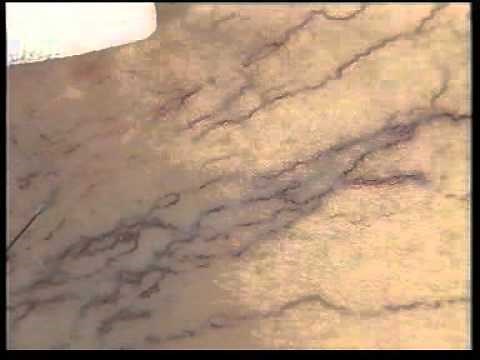 Sclerotherapy for thread veins