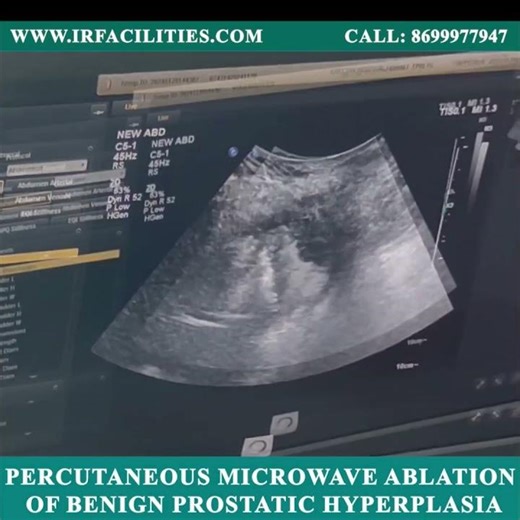 Percutaneous Microwave Ablation of Benign Prostatic Hyperplasia | IRFACILITIES