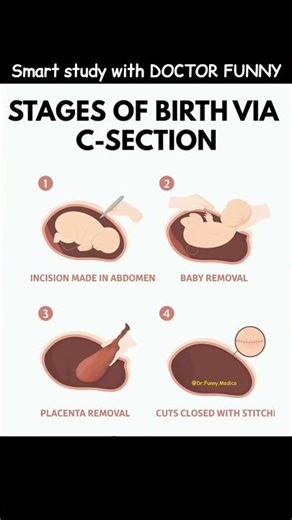 "How a C-Section Birth Happens in 4 Steps 👶✂️" #shorts #education #anatomy #doctor #shortsfeed