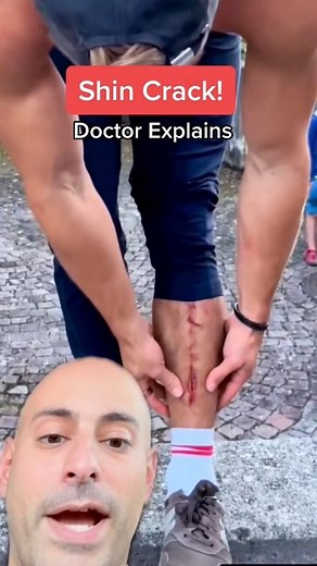 Watch them tibias! The tibia bone in front sits just below the skin with very little soft tissue. It is considered superficial (close to skin). Much respect to @simi_brunner 🏃‍♂️ 😷✅Follow @dr.davidabbasi for More Daily Medical Content & Health Tips! #simibrunner #americaninjawarrior #ninja #warrior #jump #tibia #gym #stunt #stuntdevil | David Abbasi, MD - Sports Medicine & Orthopedic Surgery