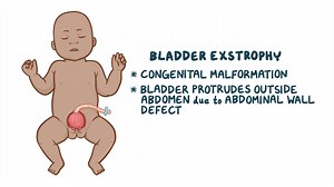 Video: Bladder exstrophy: Nursing - Video Explanation! | Osmosis | Osmosis