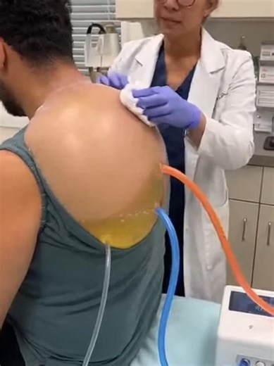 Giant Lipoma Removal: Satisfying Surgery What is This Lump? Cyst vs. Tumor Explained Removing a 5lb Mass From Patient's Back Giant Cyst Drainage – Instant Relief! Why You Should Never Ignore a Lump Like This 15-Year-Old Lump Finally Removed (Shocking Result) Lipoma vs. Cyst: How to Tell the Difference Massive Abscess Drained: Medical Case Study The Biggest Lump I’ve Seen This Year Signs Your Lump Might Be Dangerous (Watch Now) #Lipoma #Cyst #Dermatology #MedicalCase #Surgery #Tumor #SkinHealth #