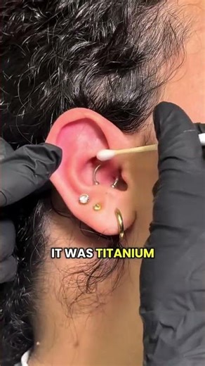 Daith Piercing Bump Rehab Pt 2 ft. Base Labs Hypochlorous Spray & Bump Oil