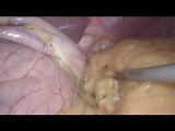 Laparoscopic Sleeve Gastrectomy • Video • MEDtube.net