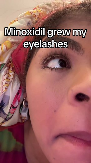 Eyelash Growth with Minoxidil