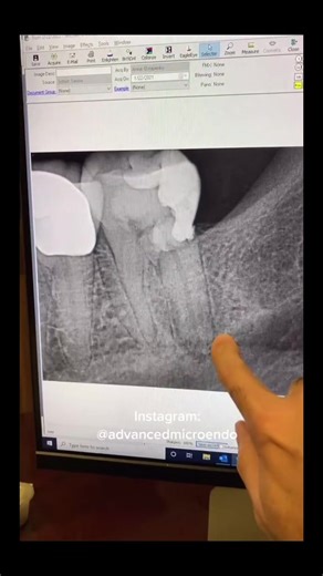 RCT of tooth 18. #dentists #rootcanaltherapy #dentalstudent #dentalschool