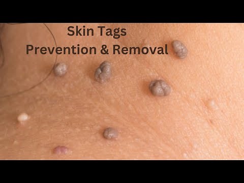 How To Remove and Prevent Skin Tags