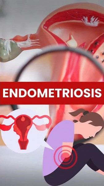 Endometriosis Surgery: A Guide to Treatment and Managing Pain