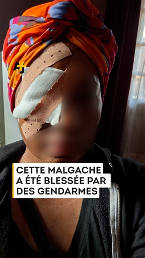 17K views · 458 reactions | À Madagascar, après plusieurs semaines d’une intense mobilisation de la jeunesse, le président Andry Rajoelina a été destitué par l’Assemblée nationale et une unité de l’armée annonce “prendre le pouvoir du pays”. Cette jeune Malgache avait reçu un projectile au niveau du visage lors des premières manifestations. Pour AJ+ français, elle témoigne : | AJ+ français | Facebook