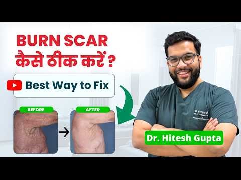 BURN SCAR कैसे ठीक करें? Best Treatment Options Explained