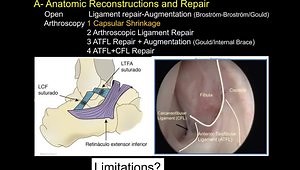Lateral Ankle Ligament Repair Techniques: Surgical Indications