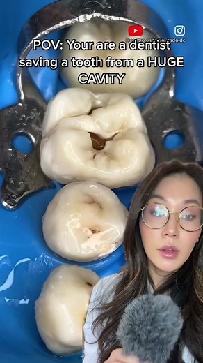 Dentistry Explained Episode 5 | when there is a large hole in a tooth,... | root canal