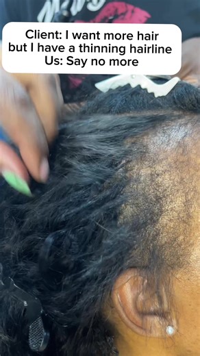 Thinning Hairline Solutions with Sew-In Extensions