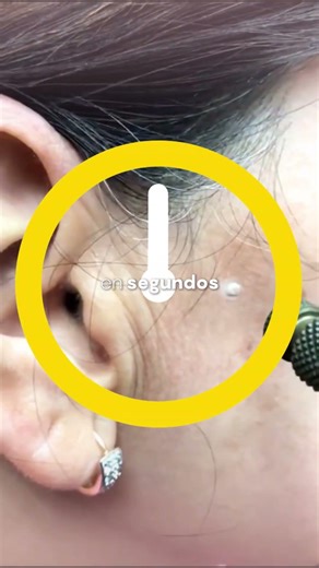 Con crioterapia puedes eliminar lunares y acrocordones de forma rápida, segura y mínimamente invasiv