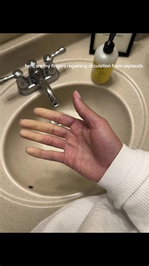 Fingers Regaining Circulation from Raynaud's