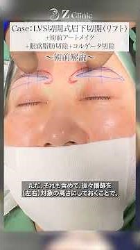 眉間のシワをあきらめないで★50代女性・眉下切開の術前説明・皺眉筋切除（コルゲータ切除）