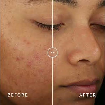 Diamond Glow Dermal Infusion