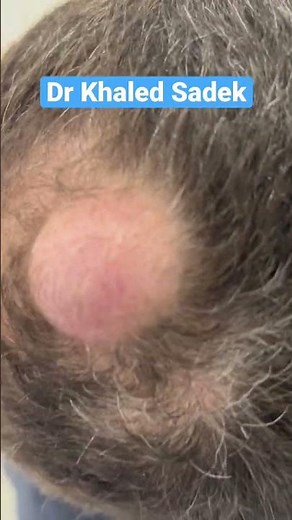 Massive Pilar cyst #blackheads #shorts #skincare Dr Khaled Sadek