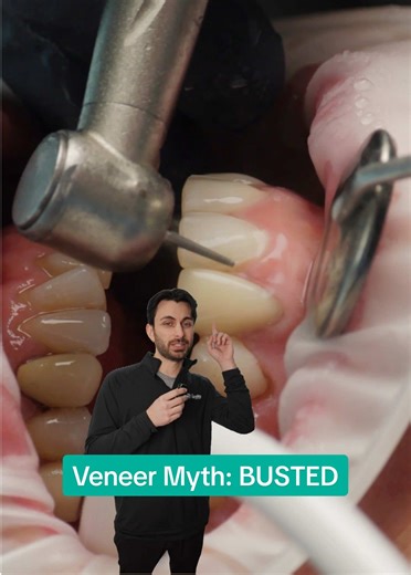 Big veneer myth: “You have to aggressively shave your teeth down.” Not true. With modern dentistry, many veneer cases require minimal prep—or none at all. Digital planning allows us to preserve healthy enamel while still creating natural, beautiful results. Great veneers aren’t about removing more tooth. They’re about doing it right. 📞 708-799-5353 | Free consultation ✅ Financing available #VeneerMyths #MinimalPrepVeneers #PorcelainVeneers #CosmeticDentistChicago #SmileMakeover