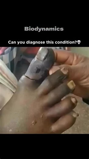 Medical | Science | Facts on Instagram: "Gangrene of the toes is a serious condition where tissue death occurs due to lack of blood flow or severe infection, often starting in the extremities like toes and fingers. It can be caused by injury, infection, or underlying conditions that affect circulation, such as diabetes or atherosclerosis. Symptoms include skin discoloration (red, purple, or black), swelling, pain or numbness, and foul-smelling discharge from sores. Early treatment is crucial to 