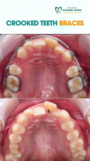 Crooked Teeth Braces #shorts #braces #orthodontist #dentistry