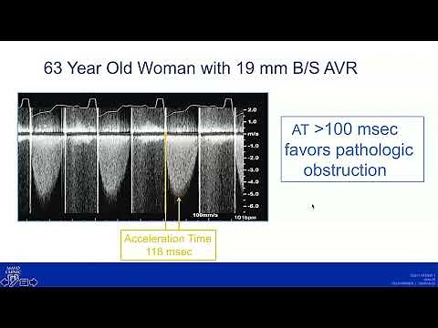 Mechanical AVR and Large Mean Gradient