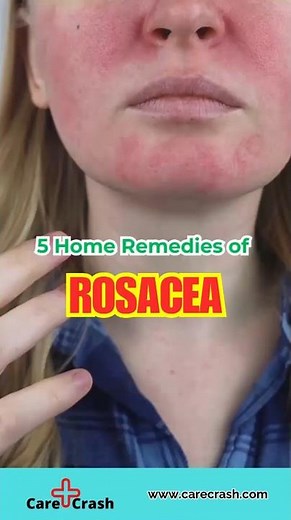 5 Effective Home Remedies for Rosacea | #carecrash