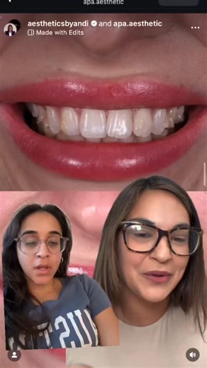 Here’s why this works like an ad without even trying, it feels like your cozy big sister giving the real talk on Invisalign & veneers. It’s warm, emotional, hits the pain points, and reminds people that our smiles live online just as much as we do. That’s why it converts.✨ Creds: @aestheticsbyandi #invisalignjourney #veneersbeforeandafter #dentistmarketing #smilemakeover | Ora Digital