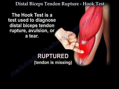 Hook Test for Biceps Tendon Rupture: Easy Diagnosis & Treatment Explained