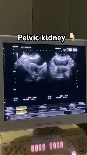 Pelvic kidney 🤌🏻 #ultrasound