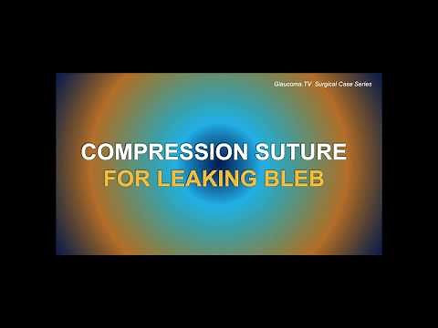 Compression suture technique for leaking bleb following trabeculectomy