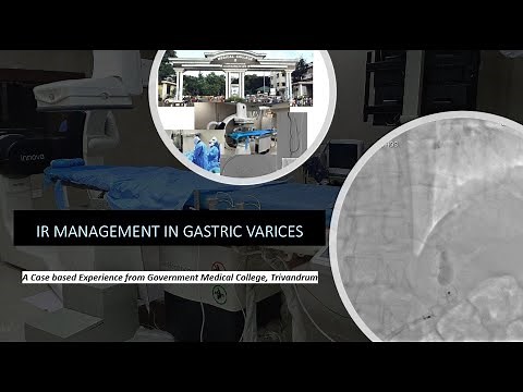 Interventional Radiology Management of Gastric Varices