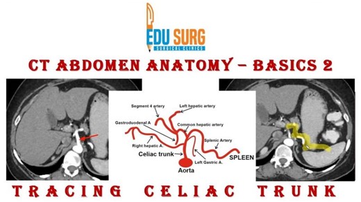 CT Abdomen Interpretation: Tracing the Celiac Axis | Gunjan Desai posted on the topic | LinkedIn