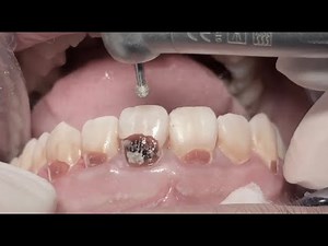 Anterior Tooth Root Canal Treatment & Composite Veneer 🦷🦷🦷