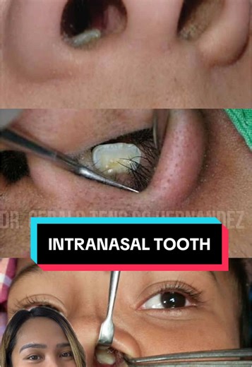 Understanding Intranasal Teeth and Ectopic Locations