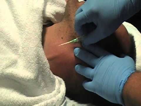 EJ IV access swing and a miss